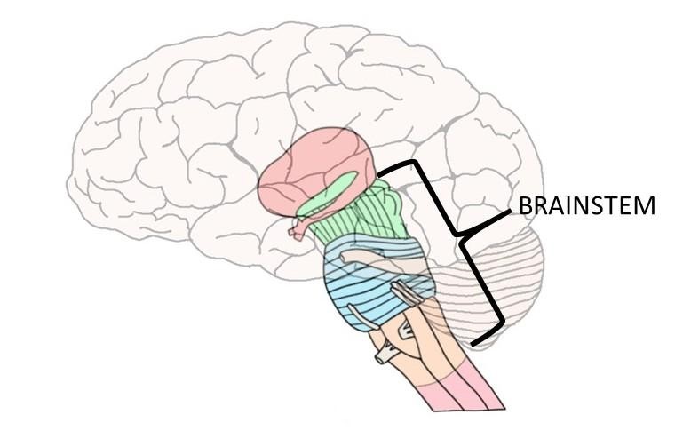 brain stem stroke diagram