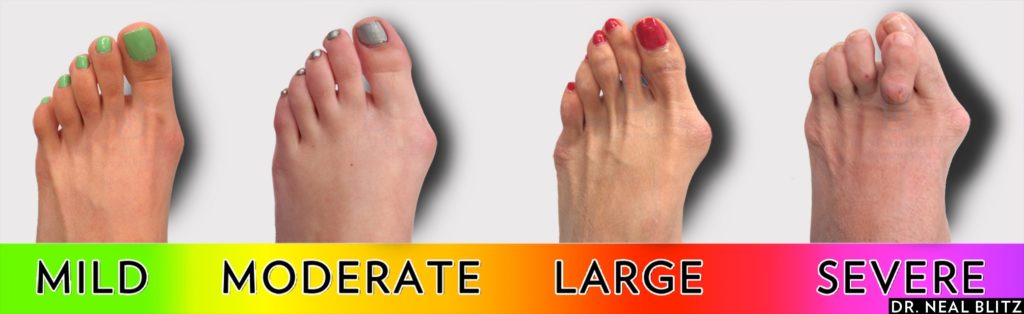 The 4 stages of a bunion